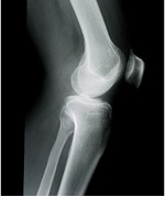 chronic left knee pain due to uni compartmental arthritis