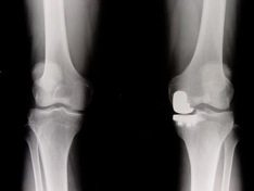 uni compartmental knee replacement