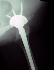 Total hip replacement through minimally invasive single incision