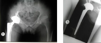 Total hip replacement done via minimally invasive single incision