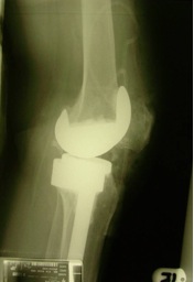X-rays showing TKR implant with good alignment