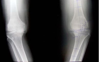 Varus both knees and osteoarthritis